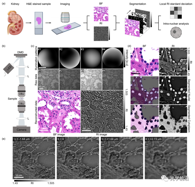 折射率层析结合明场成像定量分析肾透明细胞癌的结构异质性