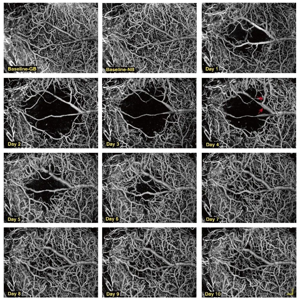 前沿 | 具有长焦深和高分辨率的光学相干层析血管造影术
