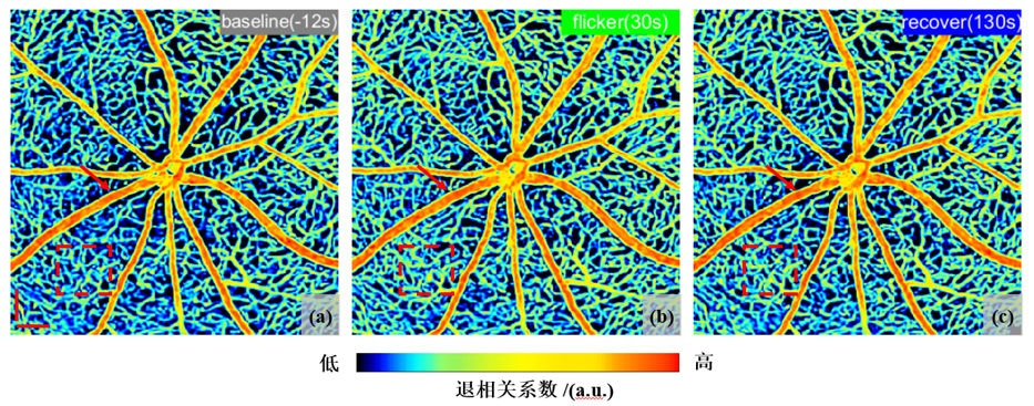 高速扫描OCT血流造影术，“看穿”眼底的秘密 |“医工融合转化”专题封面
